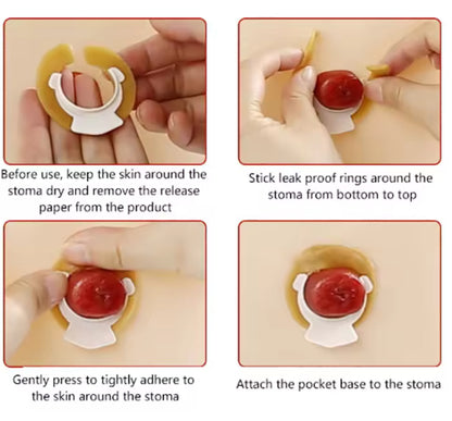 Ostomy Seal / Barrier Ring